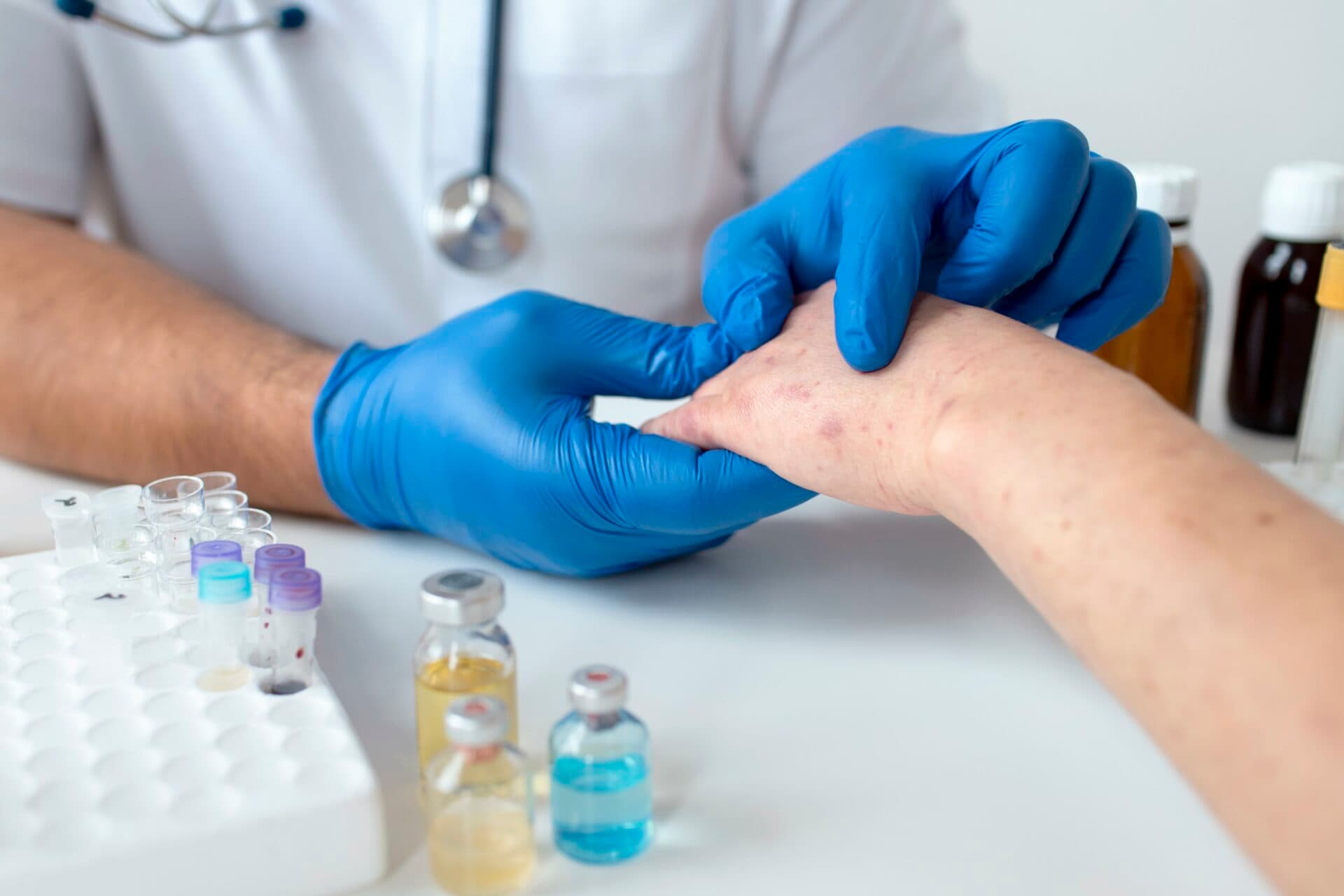 Tri nové prípady osýpok na Slovensku, hygienici očakávajú nárast
